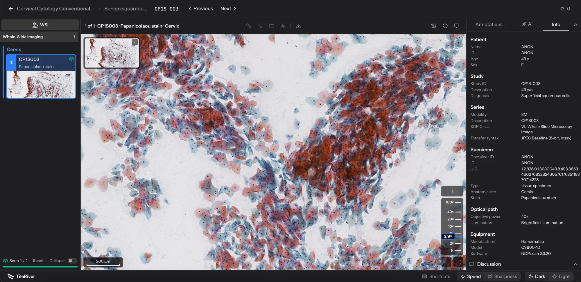 TileRiver viewer on desktop showing a cervical cytology slide with case thumbnails and the Info panel