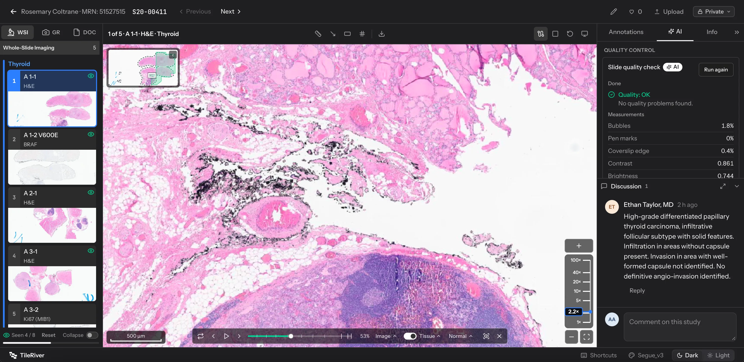 TileRiver viewer showing an H&E whole-slide image with case thumbnails, slide quality check, and discussion