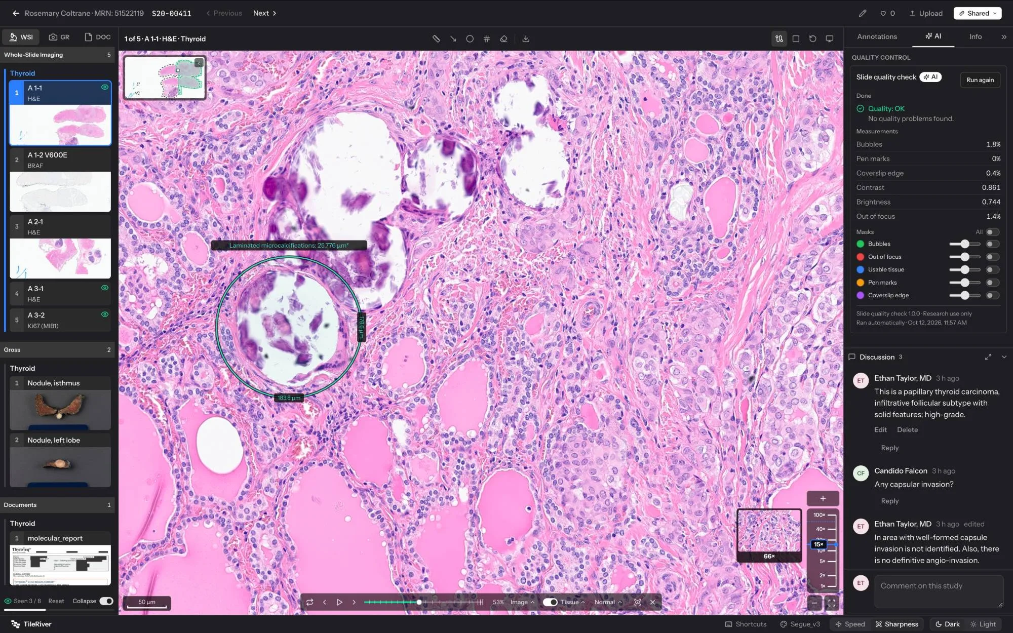 TileRiver viewer showing an H&E whole-slide image with case thumbnails, slide quality check, and discussion
